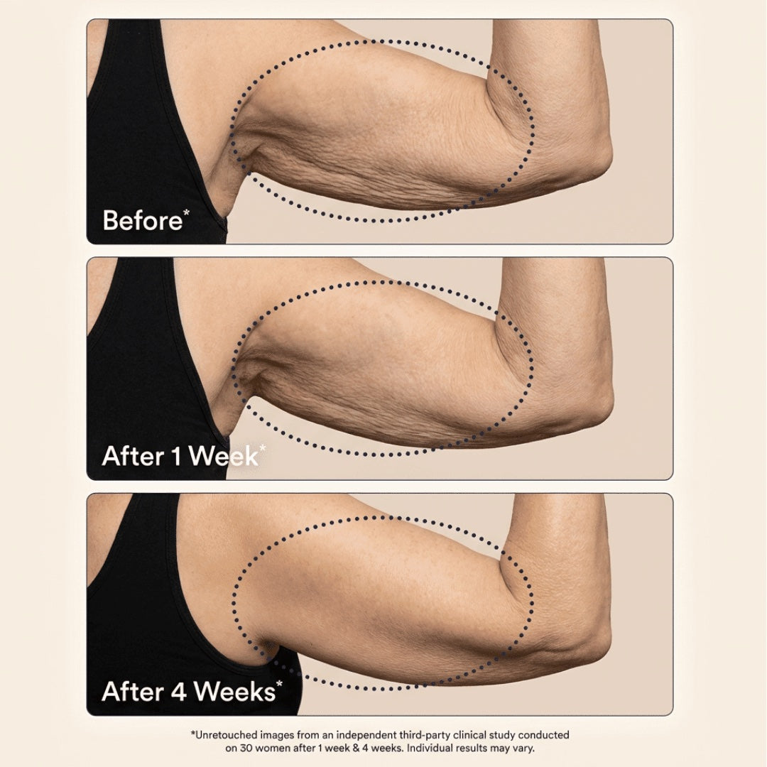 Before and after results on upper arms over 4 weeks